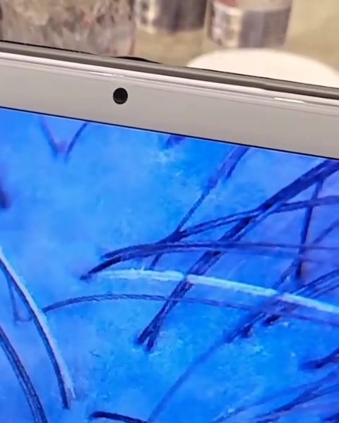 Magnified scalp analysis image on a tablet screen